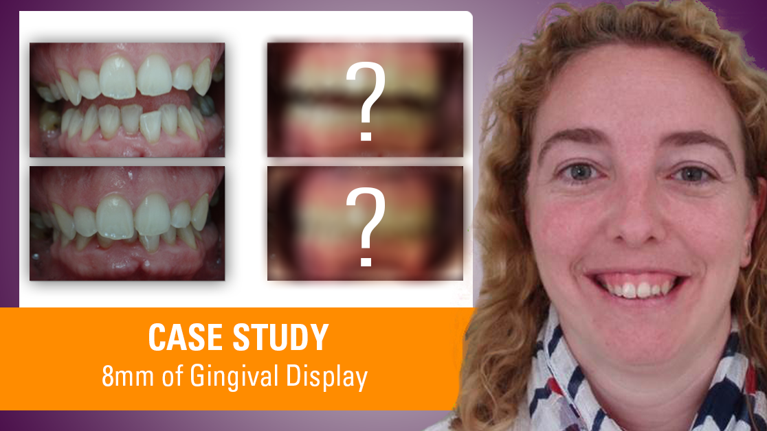 How to Treat 8mm of Gingival Display A Dentofacial Orthodontic Case Study